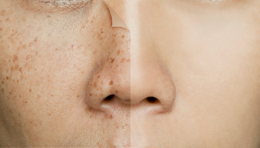 Acne Dark Spot Removal