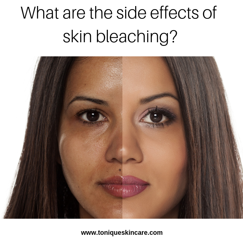 What are the Side Effects of Skin Bleaching?