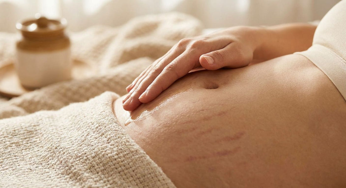 How to fade discolored stretch marks