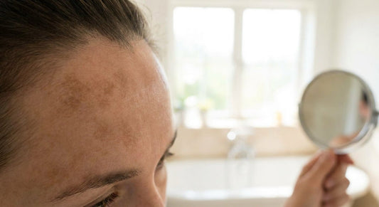 How to fade melasma on the forehead
