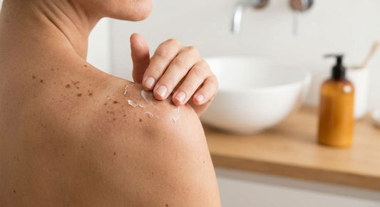 How to fade dark spots from a sunburn peel