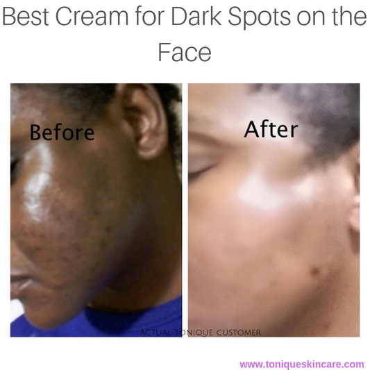 best cream for dark spots article picture