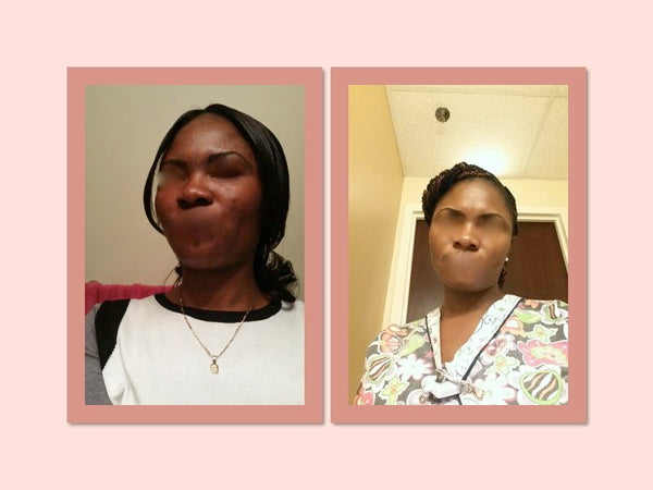 What Causes Dark Spots On The Face And How To Remove Them Tonique Skincare