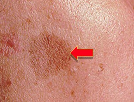 Skin Lightening Cream for Melasma