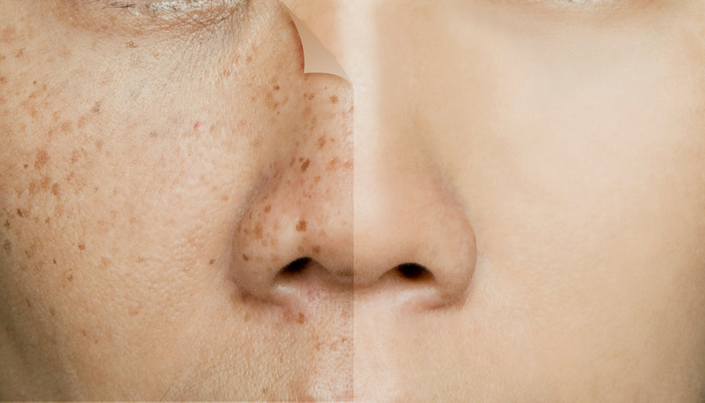 Acne Dark Spot Removal