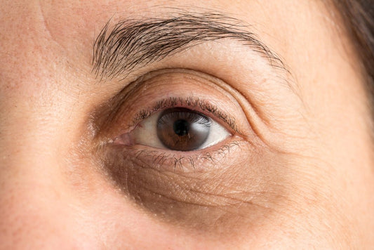 dark circles