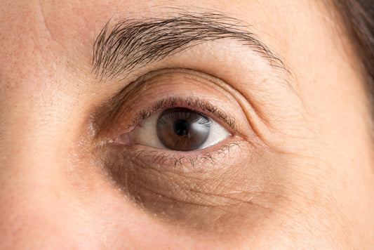dark circles