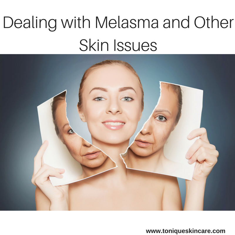 Dealing with Melasma and Other Skin Issues