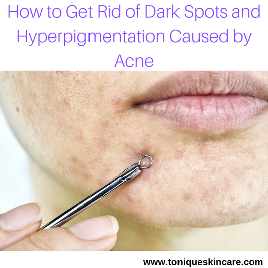dark spots and acne pic