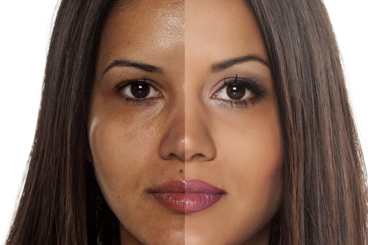 split screen of woman with blotchy and even toned skin