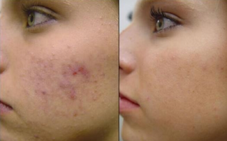 Hyperpigmentation Removal