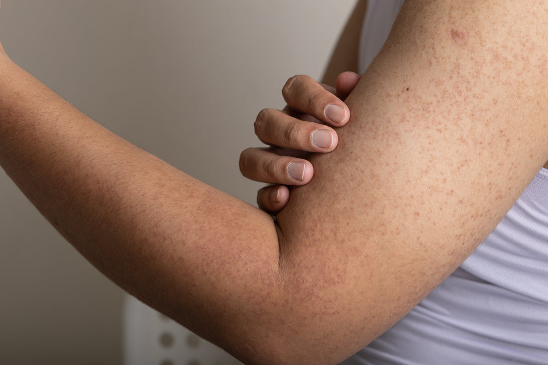 keratosis pilaris