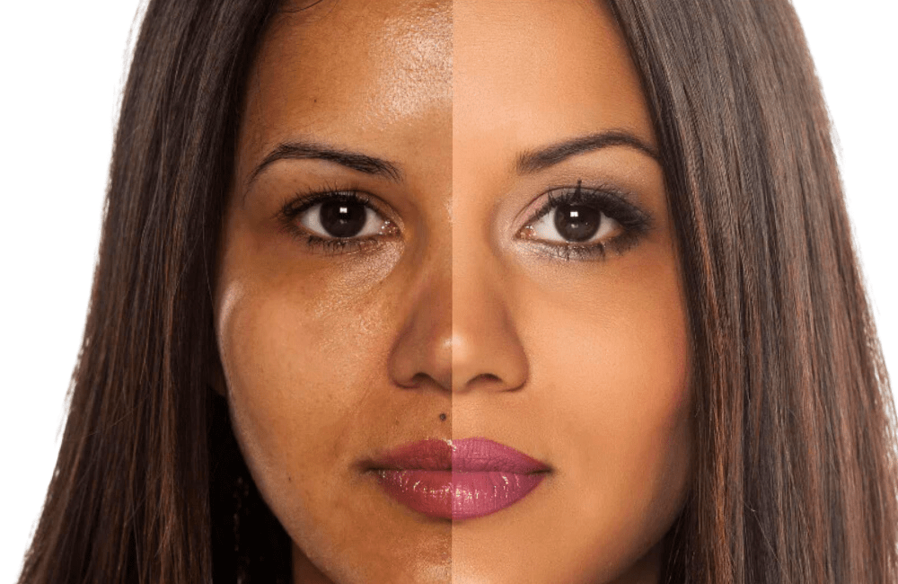 Process of Skin Bleaching: Pros and Cons