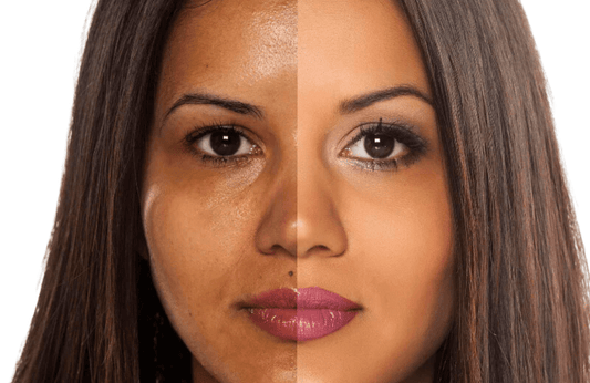 Process of Skin Bleaching: Pros and Cons