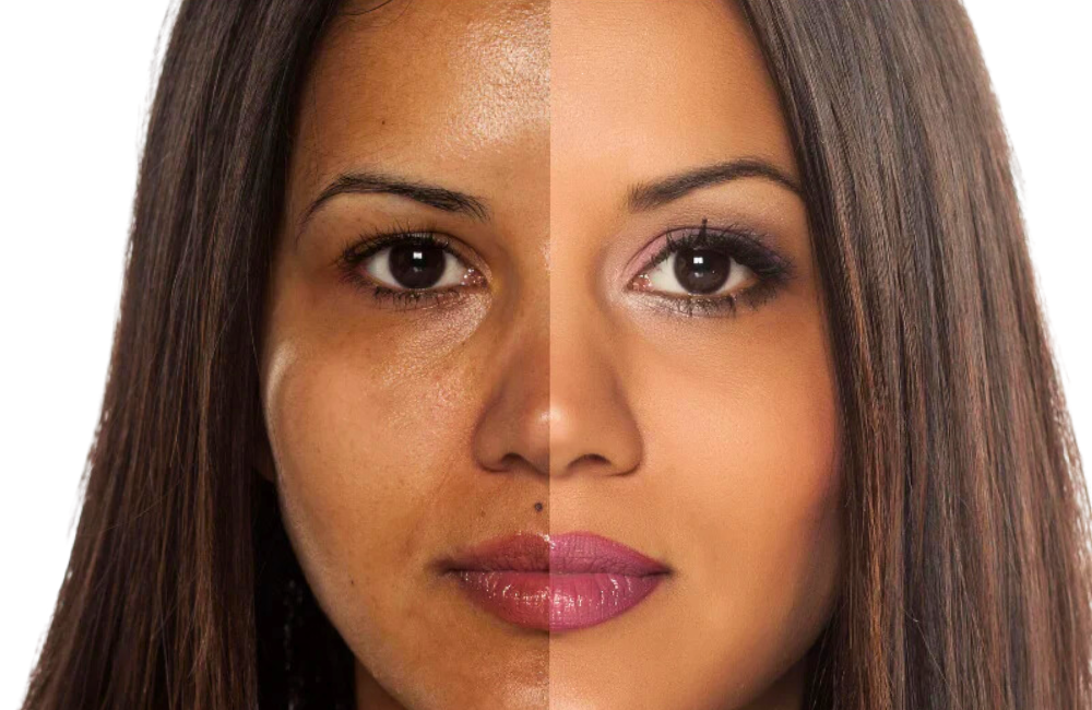 Process of Skin Bleaching: Pros and Cons