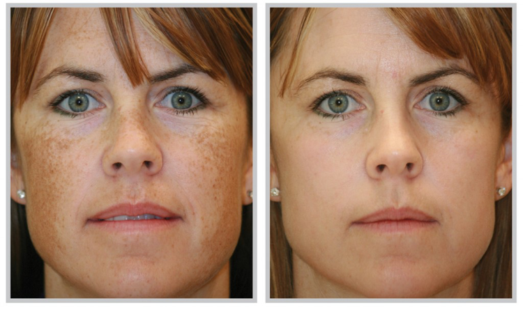Melasma Removal