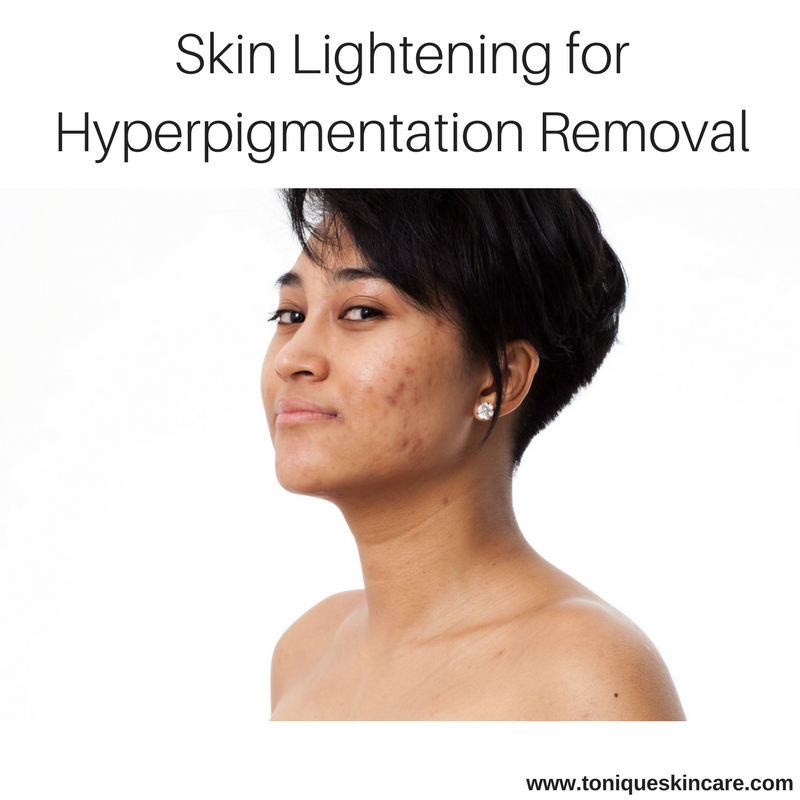Skin Lightening for Hyperpigmentation Removal