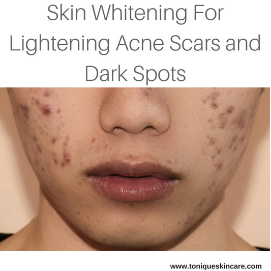 lightening acne scars and dark spots