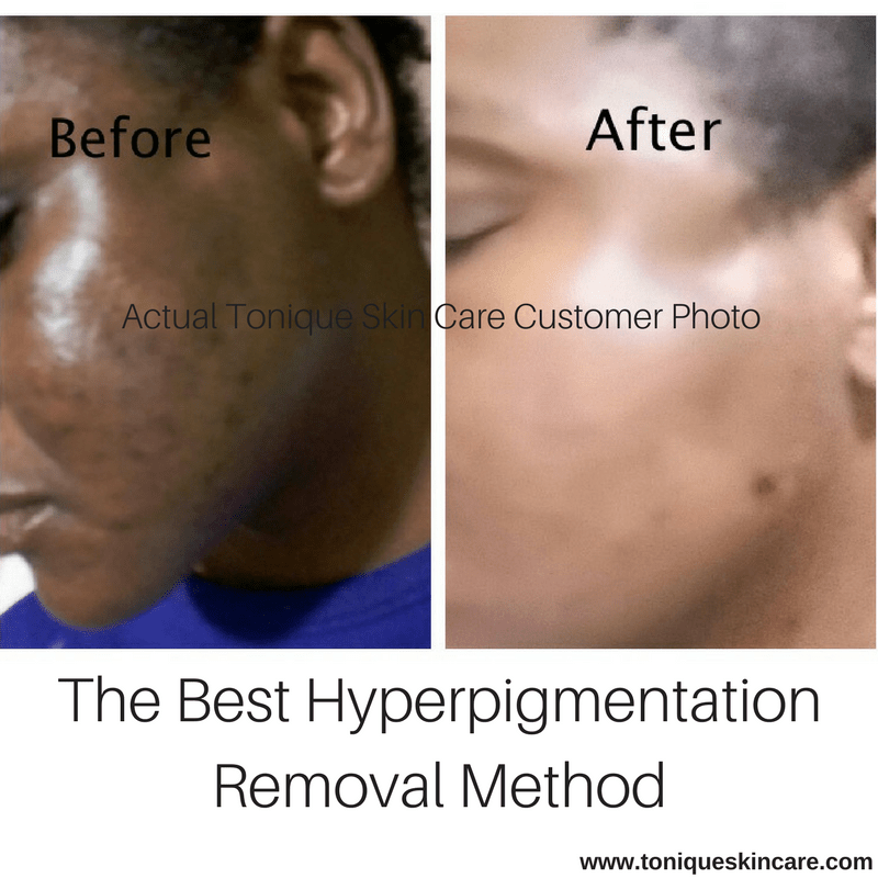 The Best Hyperpigmentation Removal Method