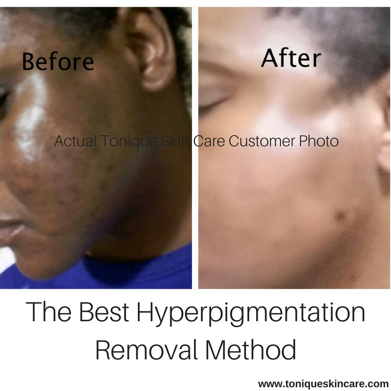 The Best Hyperpigmentation Removal Method