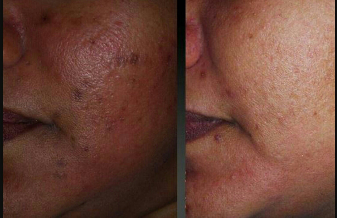 Lightening Hyperpigmentation Without Using Chemicals
