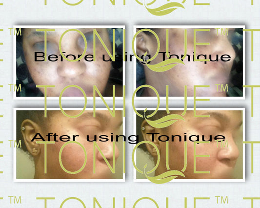Organic Ingredients In Natural Skin Bleaching Cream that Will Remove Dark Spots