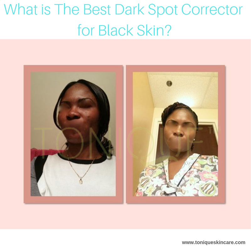 What is The Best Dark Spot Corrector for Black Skin?