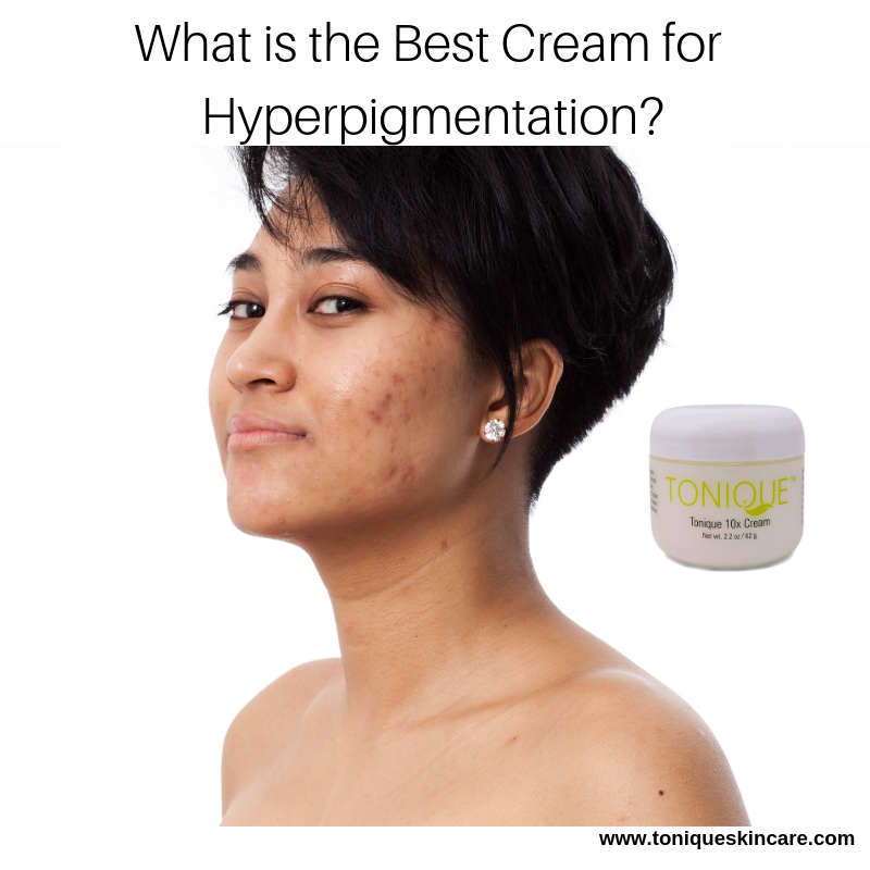 best cream for hyperpigmentation article pic