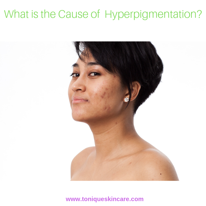 What is the Cause of Hyperpigmentation?