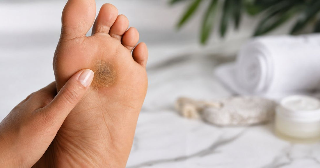 How to fade a callus-related dark patch
