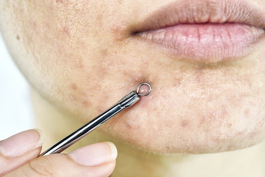 How to Remove Hyperpigmentation from the Skin