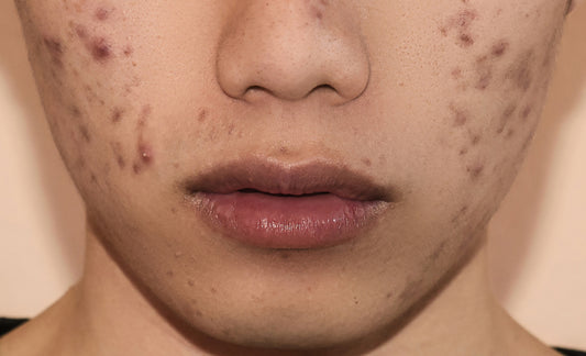 How to Remove Dark Spots Caused By Pimples