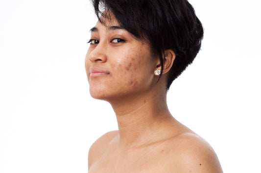 Woman with hyperpigmentation
