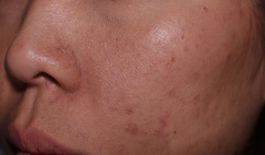 What Causes Dark Spots?