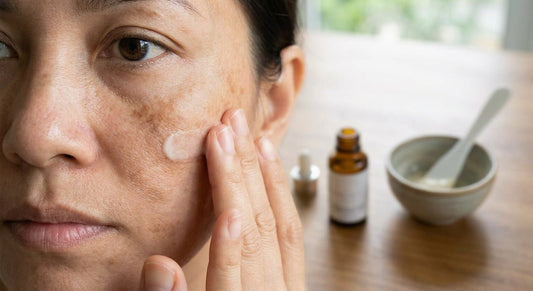 How to fade melasma on the cheeks