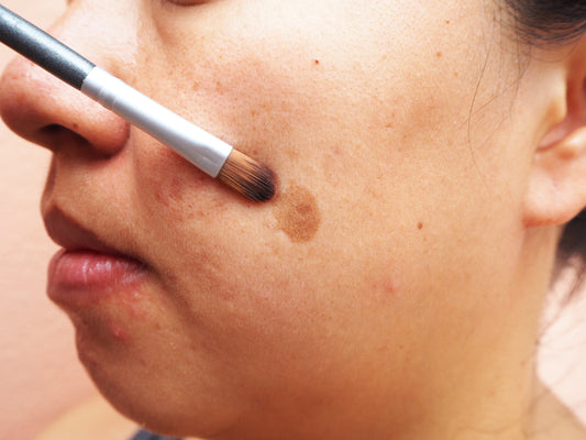 How do you treat hyperpigmentation?