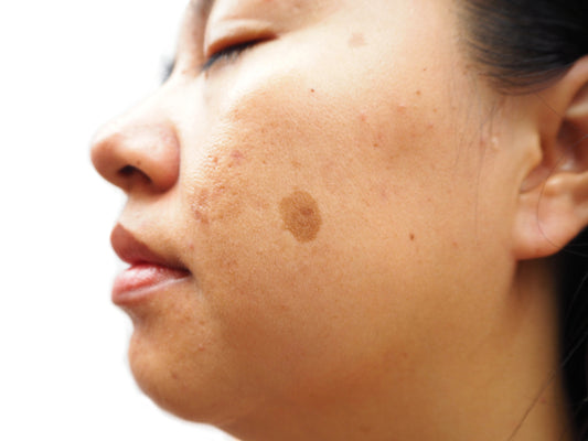 Melasma: How Can I Treat It?