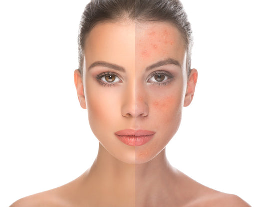 Lightening Melasma and Hyperpigmentation